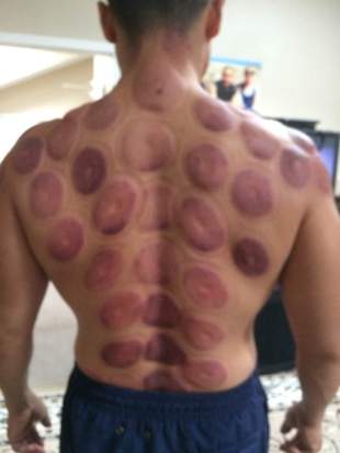 cupping